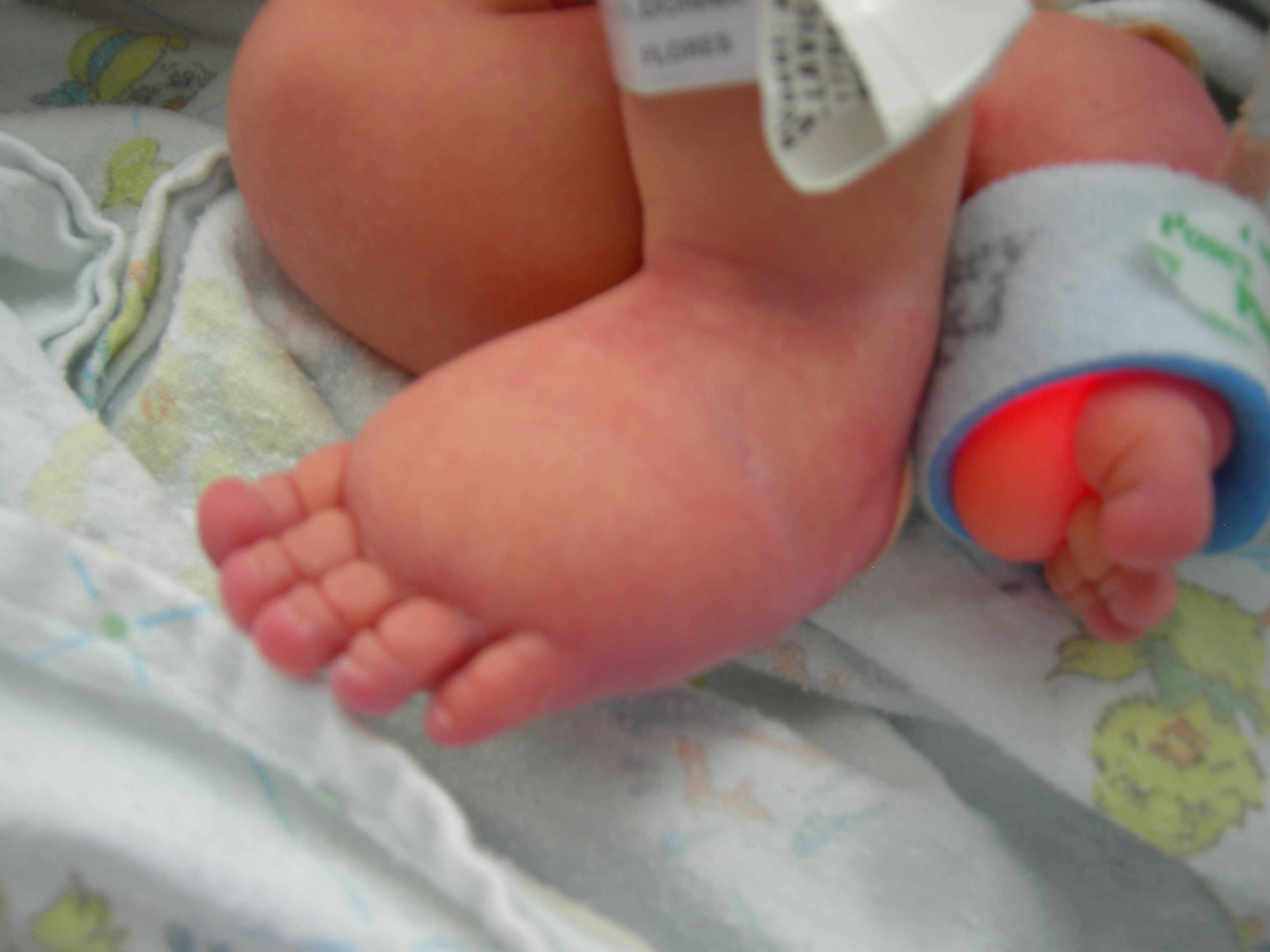 Newborn lymphedema